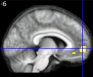 大脑内侧眶额叶皮层的A1区